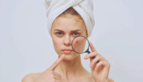 5 Ways to Deal with Acne Scars