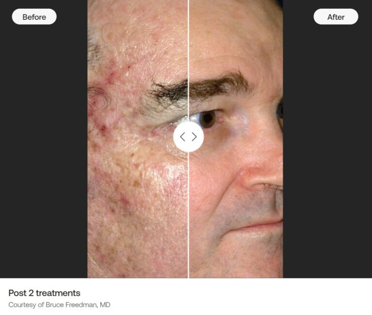 before-and-after-microlaserpeel-envy-skin-clinic