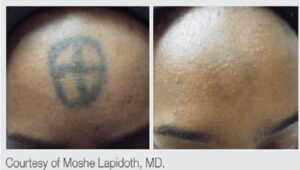 A laser that can safely and quickly remove unwanted tattoos