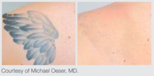 This laser can effectively remove tattoo one no longer wants.