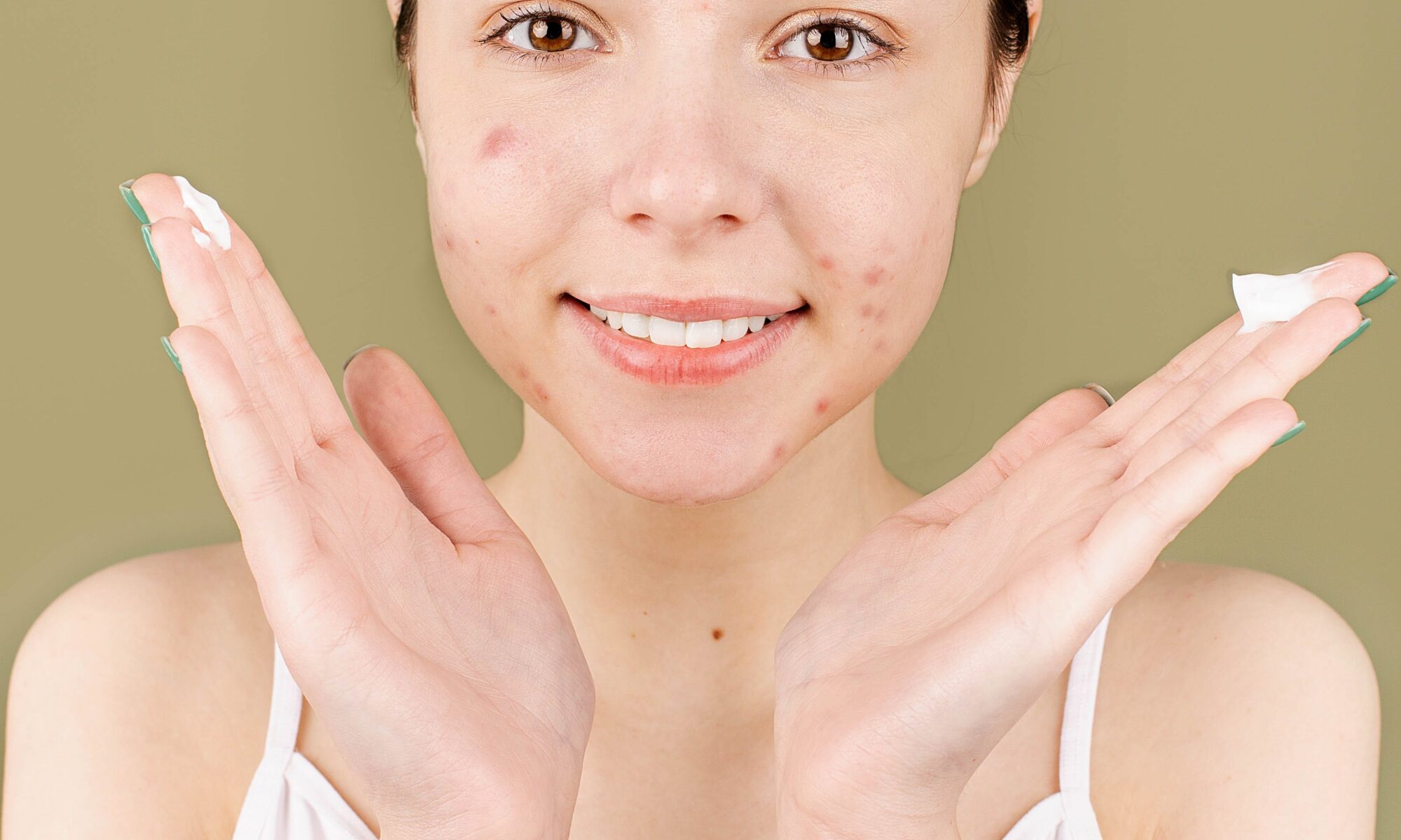 Acne Scar Treatments Minneapolis