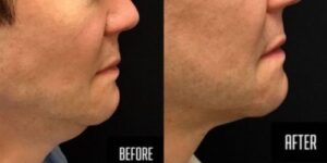 facial-sculpting-before-and-after